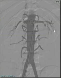 Renal Intervention