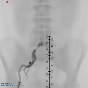 Iliac intervention