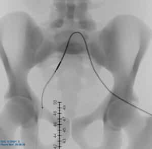 Lower Extremities CTO