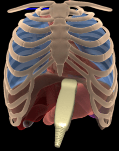 Pericardiocentsesis