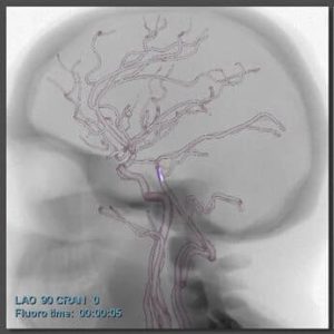 Acute Ischemic stroke