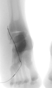 Below the knee
