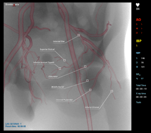 Prostatic artery embolization