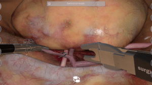 Nephrectomy