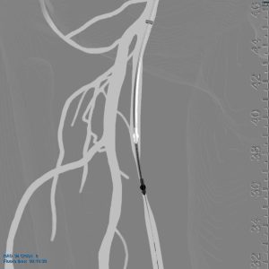 Atherectomy