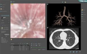 Diagnostic bronchoscopy