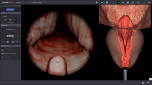 TURP Full Procedure