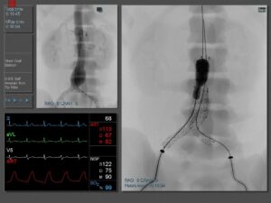 Endovascular Aneurysm repair (EVAR)