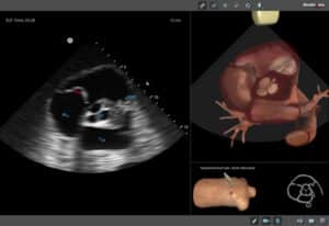 bedside echocardiography