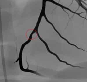 Coronary Bifurcation