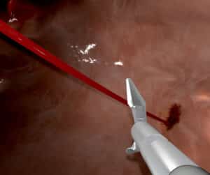 Emergency bleeding