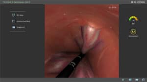 Flexible signoidoscopy