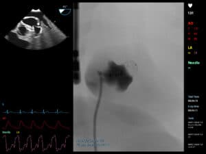 LAA Closure