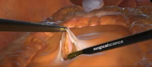 Colorectal
