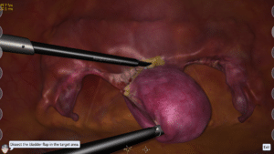Hysterectomy