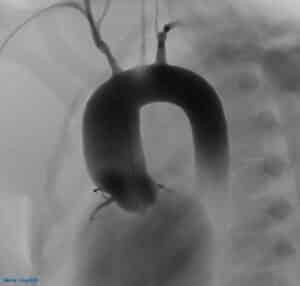Transradial coronary intervention