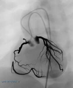 Coronary CTO