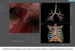 Emergency bronchoscopy