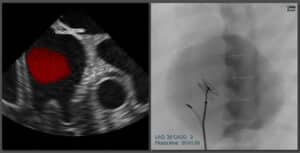 ASD-PFO closure