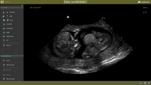 OB 1st Trimester