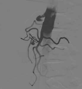 Endovascular trauma management