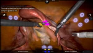 Guided Adnexa Preservation