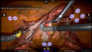 Guided Salpingo Oophorectomy