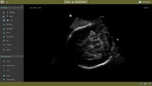 Fetal Neurosonography