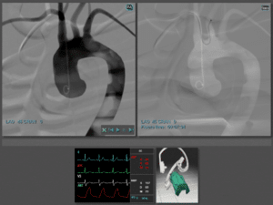 Transradial Cerebral