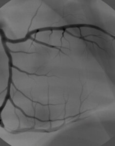 Coronary intervention