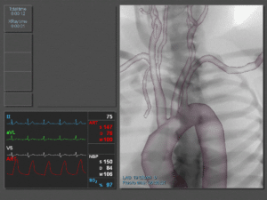 Carotid intervention
