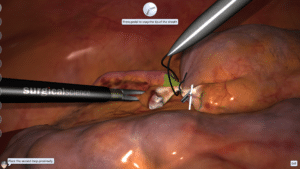 Appendectomy