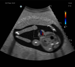OB 2nd Trimester