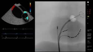 AF Ablation