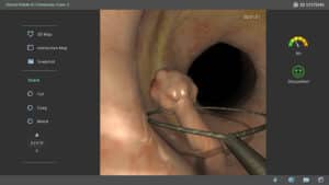 Lower GI endoscopy