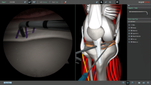 Meniscal Repair