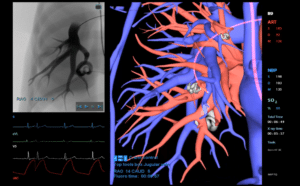Advanced embolization