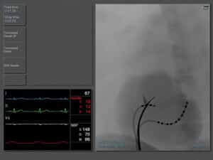 Transseptal puncture