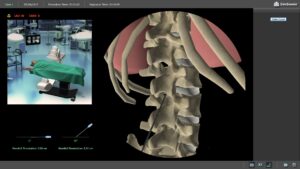 Spinal Cord Stimulation
