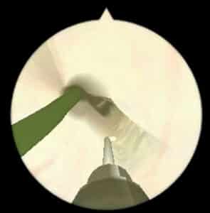 Stricture treatment