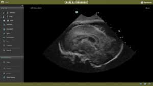 Fetal echo