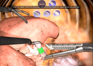 Stapler Selected for ligation