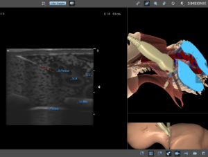 brachial plexus nerve block