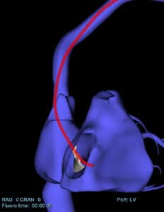 Cardiac rhythm management