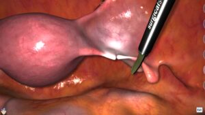 Gynecology