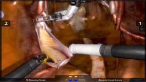 Ureter dissection