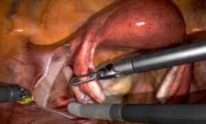 Ureter identification