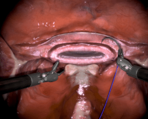 Vaginal Cuff Closure