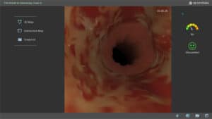 Upper GI endoscopy