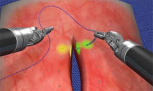 Vertical defect suturing
